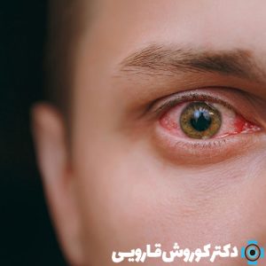 خشکی چشم و علل آن | خشکی چشم 