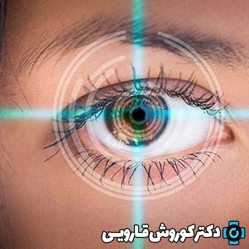 سن مناسب برای عمل لیزیک چشم
