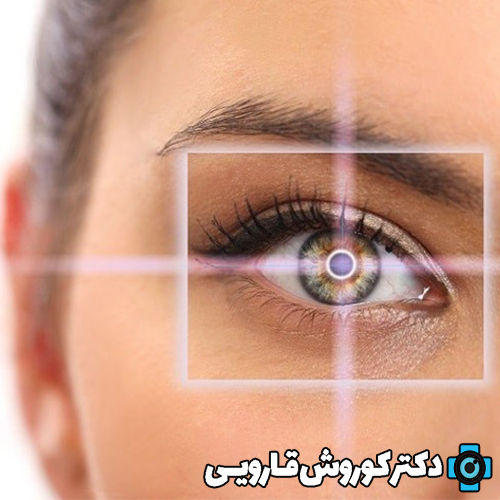 مراقبت‌های بعد از عمل لیزیک چشم