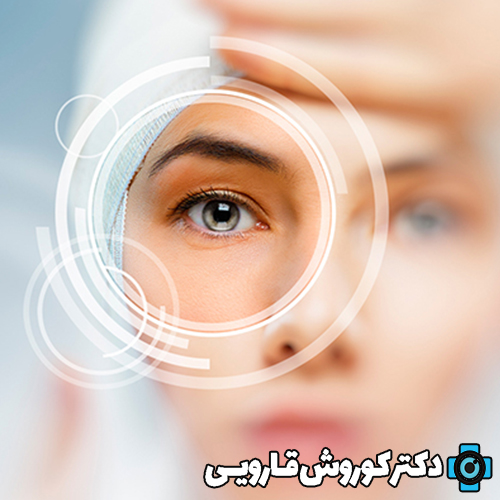 عمل جراحی لازک چشم برای چه کسانی مناسب است؟