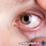 انواع بیماری‌های چشمی