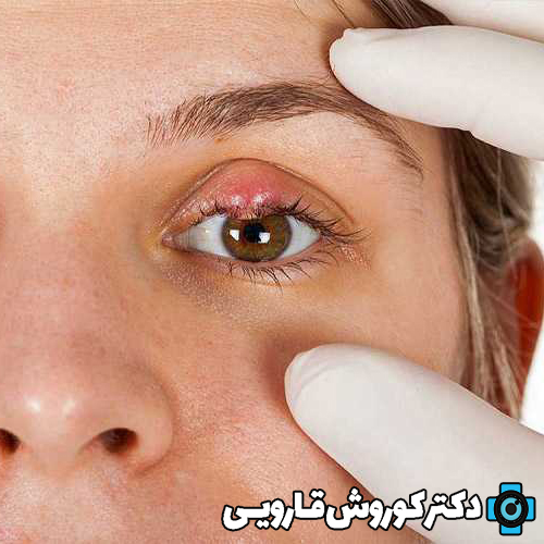 مقایسه گل مژه و شالازیون