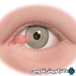 ناخنک چشم چیست و عمل آن چگونه انجام می‌شود؟