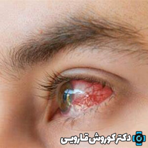 رابطه بین لیزیک و جراحی بینی چگونه است؟