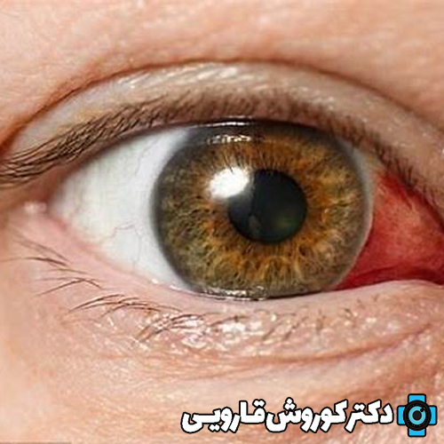 انواع کراتیت (التهاب قرنیه) و درمان آن چیست؟