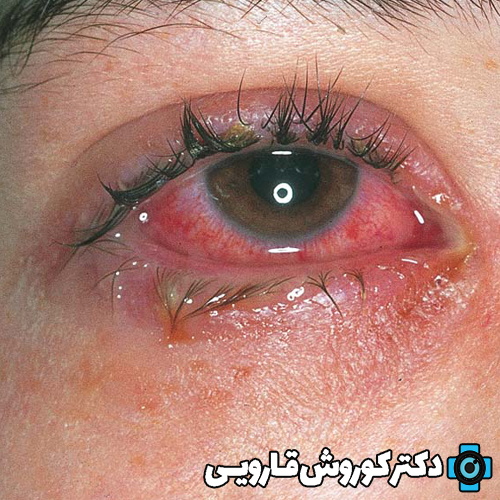 اندوفتالمیت و درمان آن چیست؟