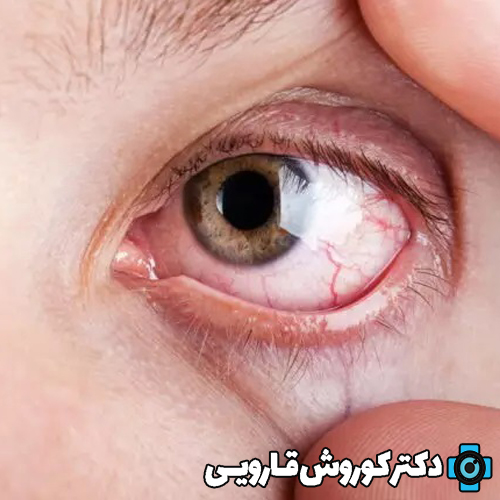 انواع کراتیت (التهاب قرنیه) و درمان آن چیست؟