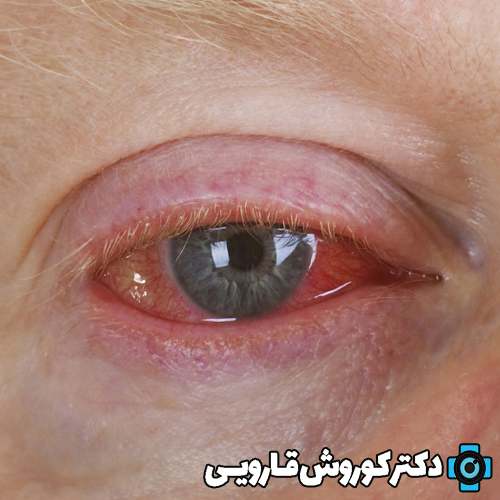 اندوفتالمیت و درمان آن چیست؟
