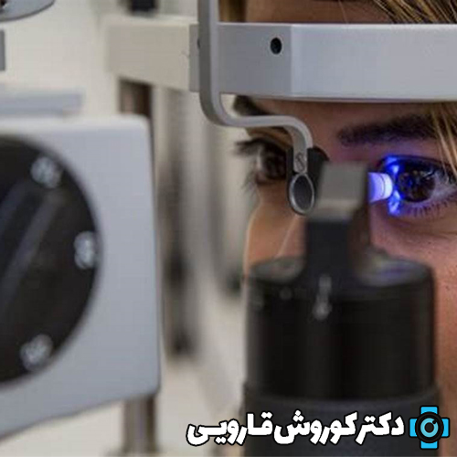دکتر کوروش قارویی جز 10 تا از بهترین دکتر قرنیه چشم در ایران