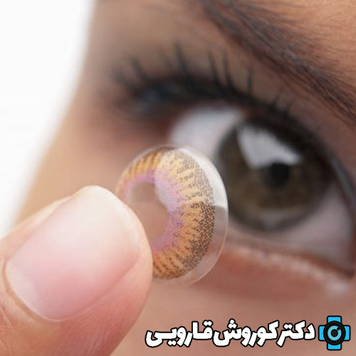 حفاظت شده: اختلالات انکساری: لنزهای تماسی و اصلاح بینایی