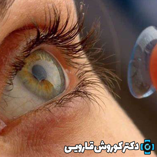 اختلالات انکساری: لنزهای تماسی و اصلاح بینایی