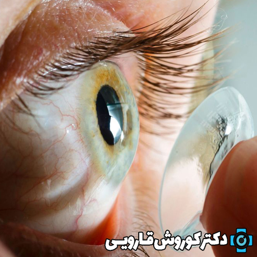 اختلالات انکساری: لنزهای تماسی و اصلاح بینایی