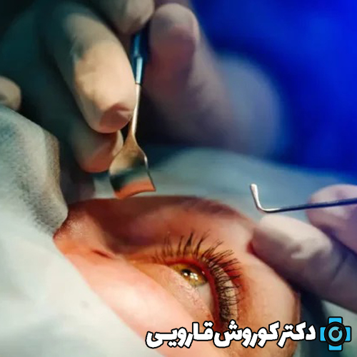 بیماری‌های قرنیه: علل، تشخیص و درمان