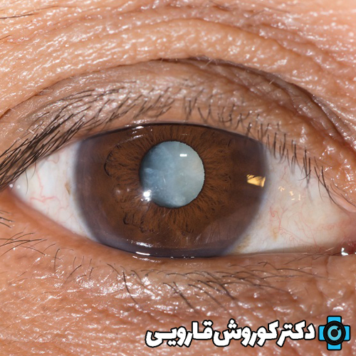 تاثیر دیابت بر سلامت چشم