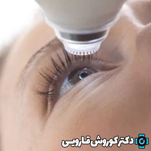 راهکار های کاهش درد چشم بعد از عمل PRK،لازک و لیزیک