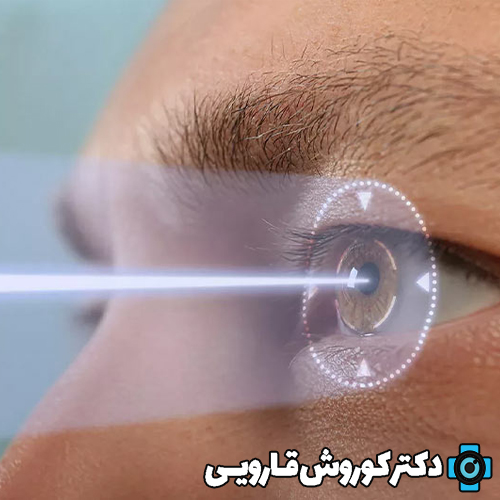 آیا بعد از عمل لیزیک چشم دوباره ضعیف میشود ؟