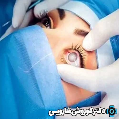 آیا بعد از عمل لیزیک چشم دوباره ضعیف میشود ؟