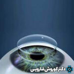 پیوند قرنیه لایه‌ای از نوع DSAEK (دزک) چیست و در چه مواردی کاربرد دارد؟
