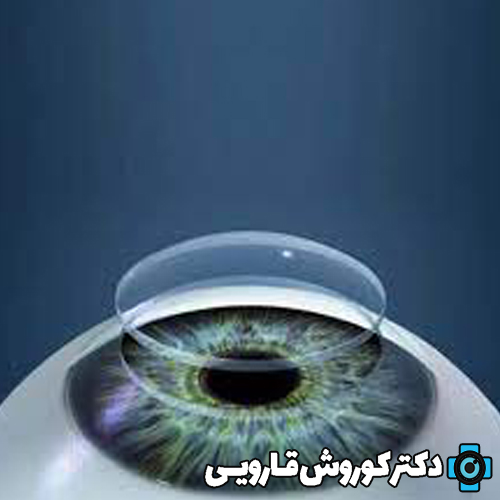 پیوند قرنیه لایه‌ای از نوع DSAEK (دزک) چیست و در چه مواردی کاربرد دارد؟