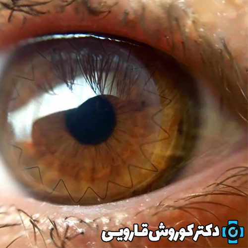 پیوند قرنیه لایه‌ای از نوع DSAEK (دزک) چیست و در چه مواردی کاربرد دارد؟