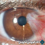 حفاظت شده: پیشگیری از بیماری‌های چشمی: نکات کلیدی برای مراقبت از چشم‌ها