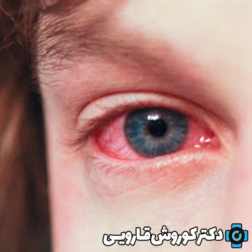 انواع بیماری‌های چشمی