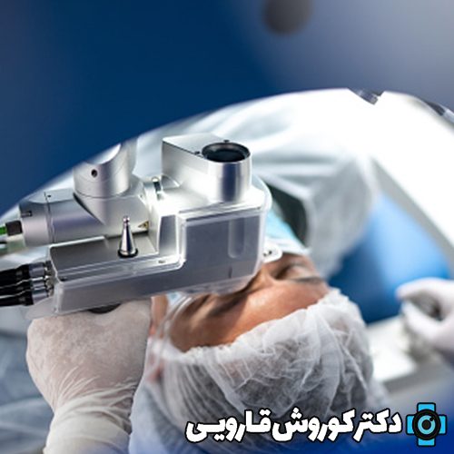 عمل جراحی لیزیک چشم در مازندران