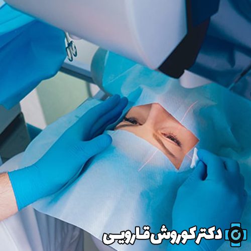 هزینه عمل لیزیک چشم در مازندران