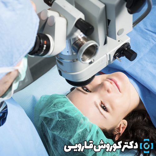 عمل لیزیک چشم در مازندران