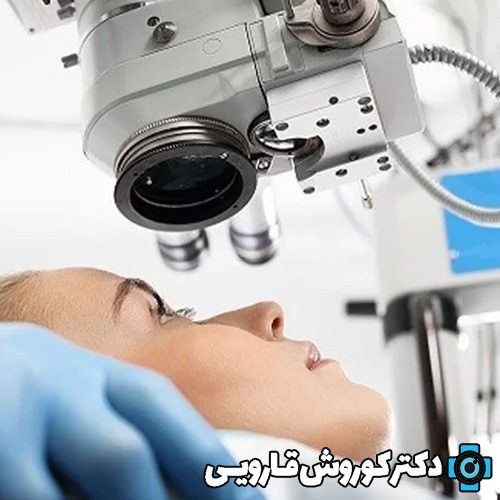 عمل جراحی لیزیک چشم