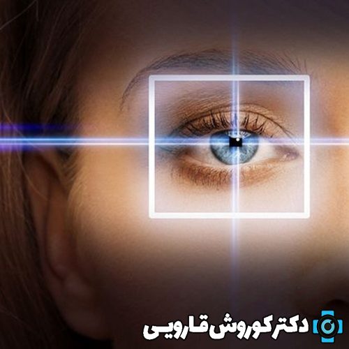 عمل لیزیک چشم در مازندران