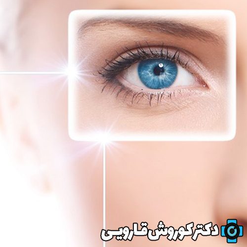 عمل جراحی لازک چشم برای چه کسانی مناسب است؟